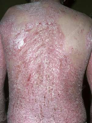 Sebopsoriasis