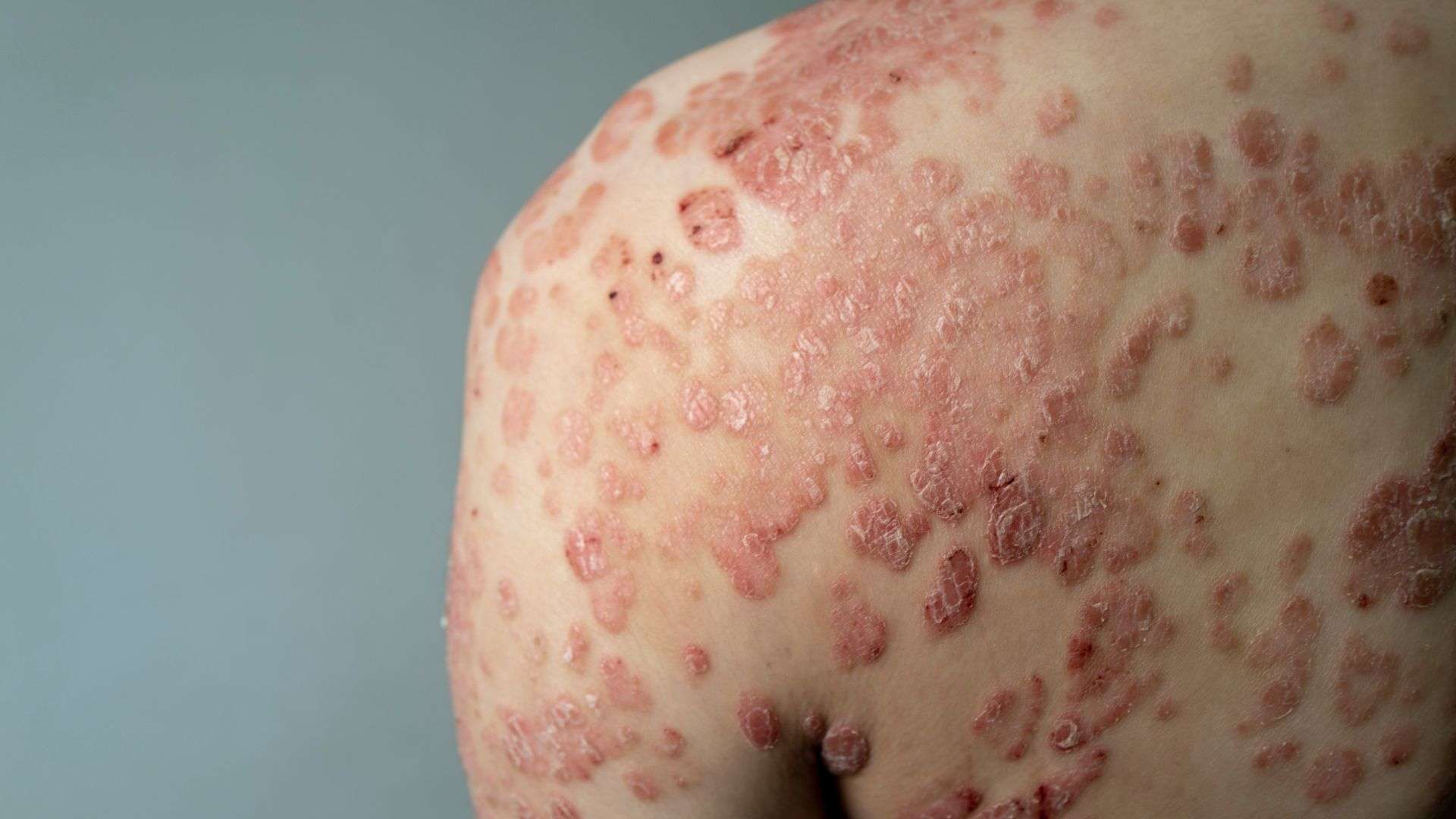 Guttate Psoriasis