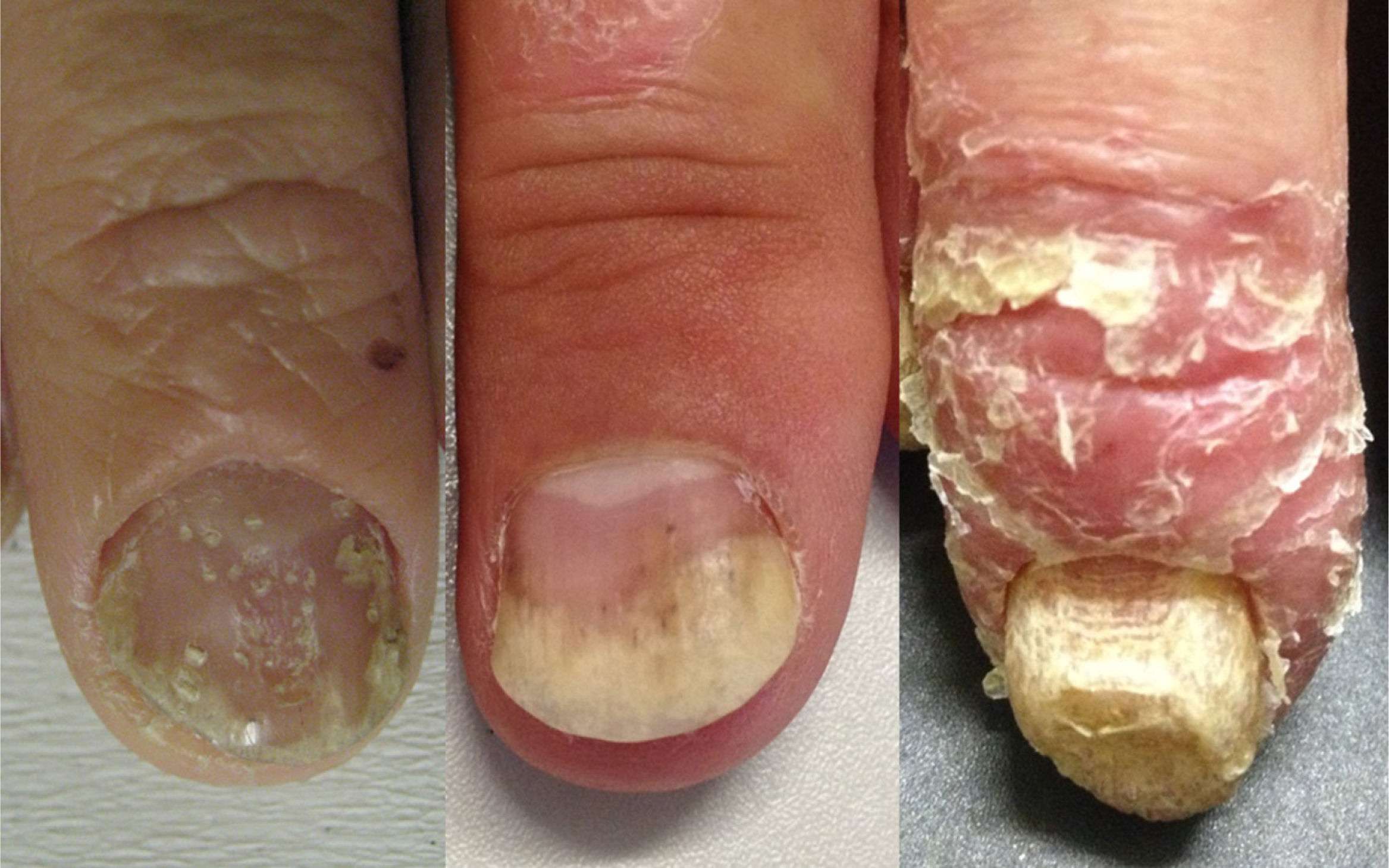 Sebopsoriasis