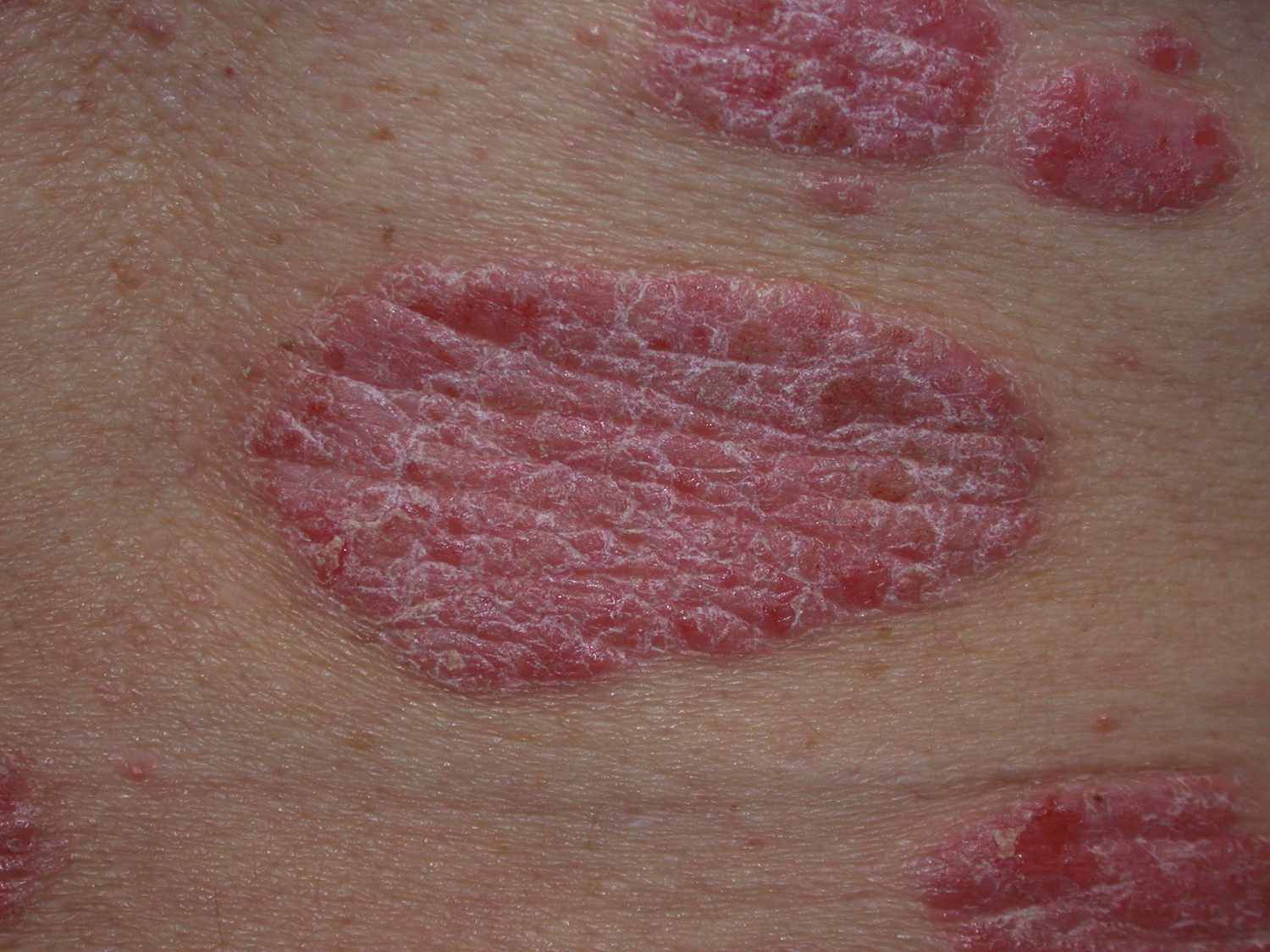 Plaque Psoriasis