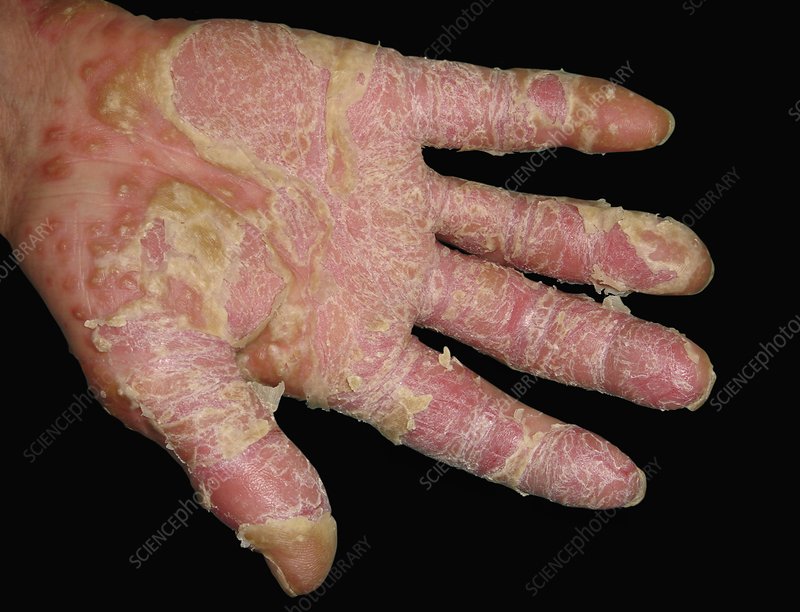 Pustular Psoriasis